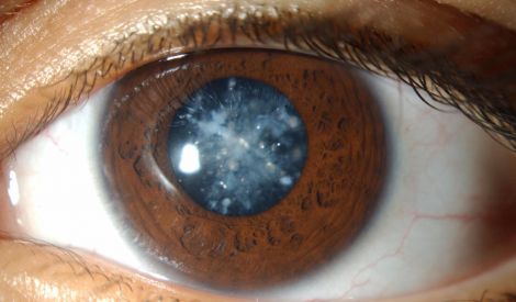 أمراض العين: المياه الزرقاء والمياه السوداء