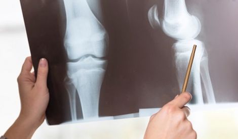 
الصحة والحياة: ترقق العظام Osteoporosis