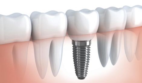 زرع الأسنان مرحلة جديدة في طب الأسنان‏